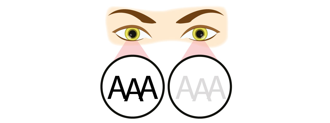 amblyopia